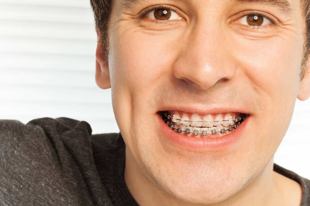 happy young man with metal braces - overbite vs underbite in Fairview, TN.